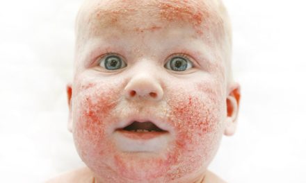 Can You Prevent Allergic Skin Reactions in Babies?