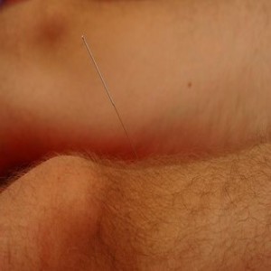 Acupuncture - leg