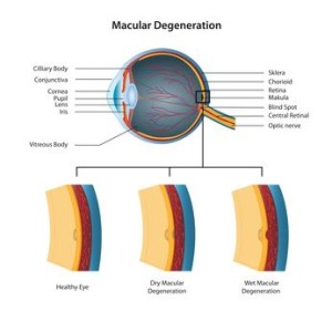 macula degeneration vector illustration