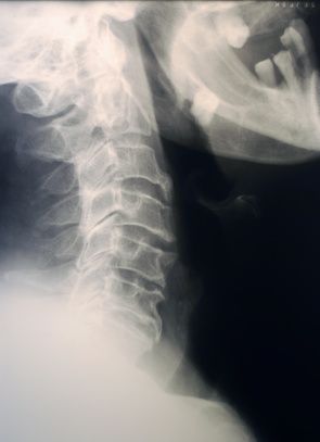X ray of neck spine