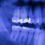 Dental Teeth Filling Dentists Xray Scan