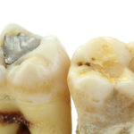 Extracted teeth with details of caries