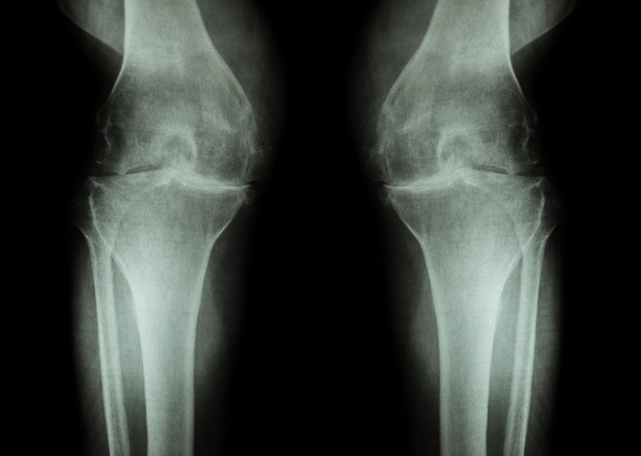 Could this be an Inexpensive way to Prevent Arthritis?