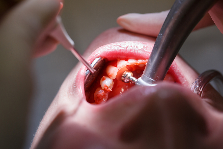 Coenzyme Q10 and Periodontal Disease
