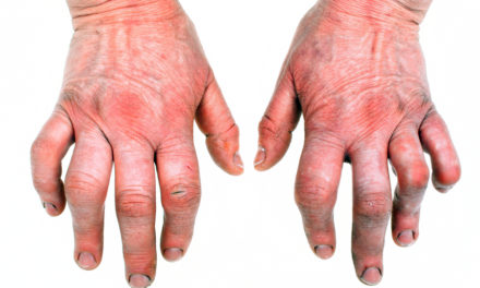 Rheumatoid Arthritis and Cod Liver Oil