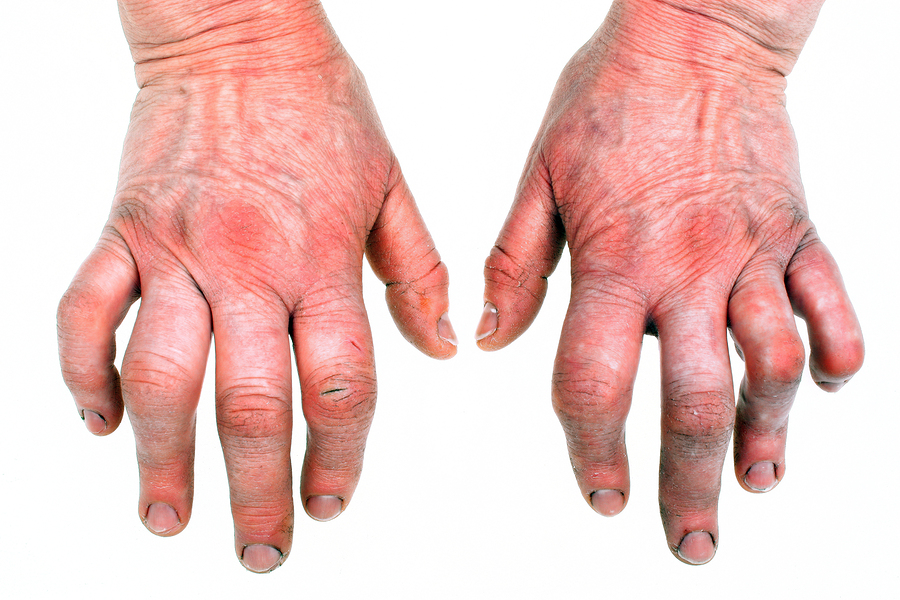 Rheumatoid Arthritis and Cod Liver Oil