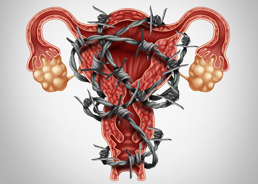 Endometriosis: A Link to Other Health Problems?