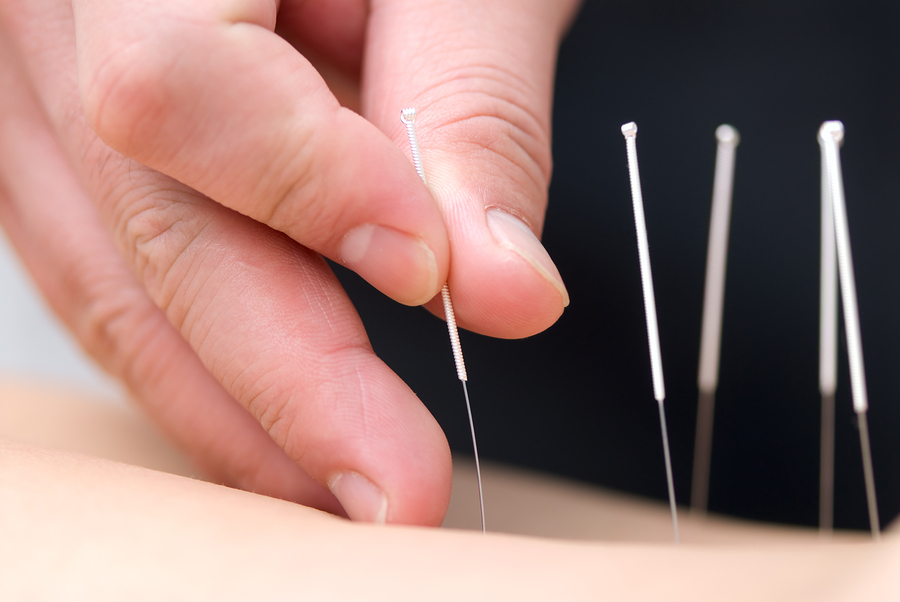 Acupuncture and Exercise Performance