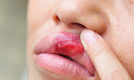 Can  Anything be Done About Canker Sores?