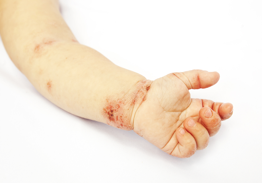 Infantile Eczema and Probiotics