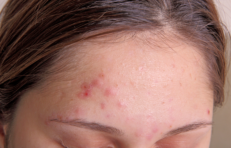 Acne and Barberry