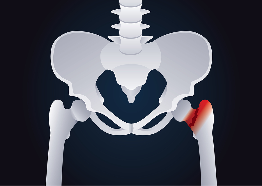 Are Antacids Linked to Hip Fracture?
