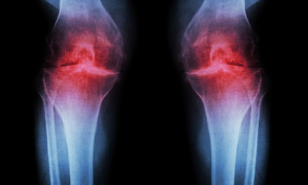 Niacinamide and Arthritis