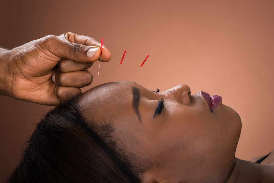 Acupuncture to Prevent Migraines
