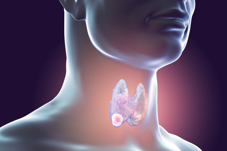 Special Report for Those Who Scored High on the Thyroid Portion of the Questionnaire