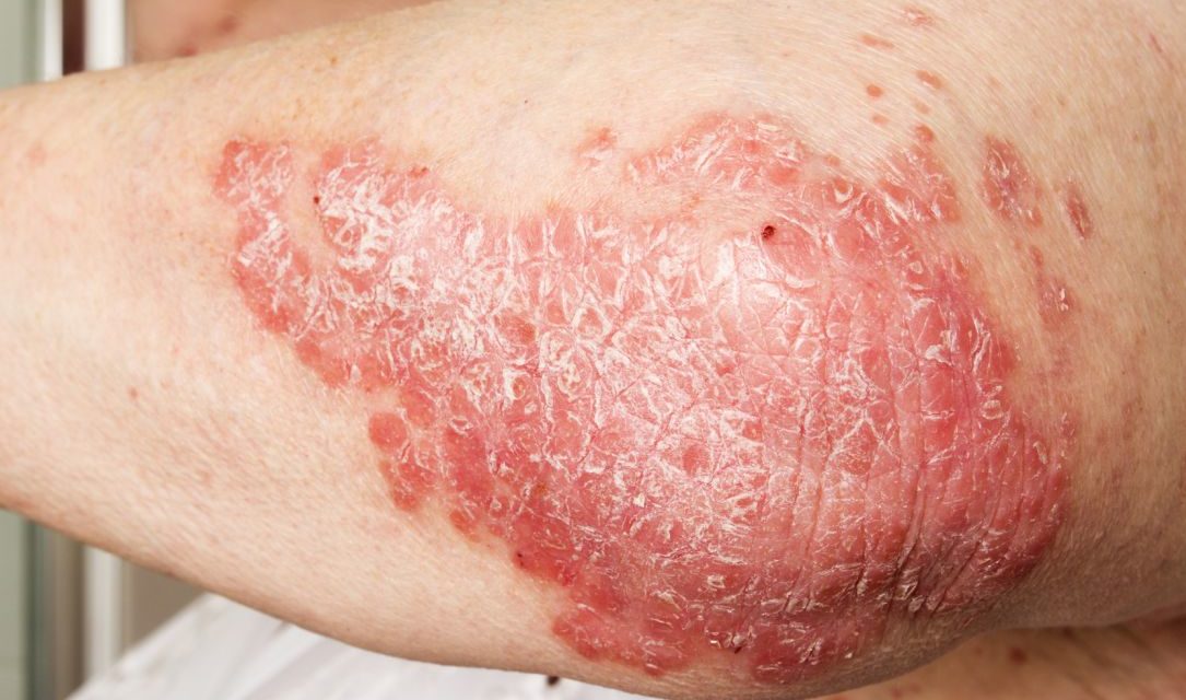 Psoriasis and Viamin D